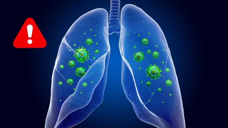 ¿Qué tan probable es que te enfermes de peste pulmonar? Esto dice la OMS 