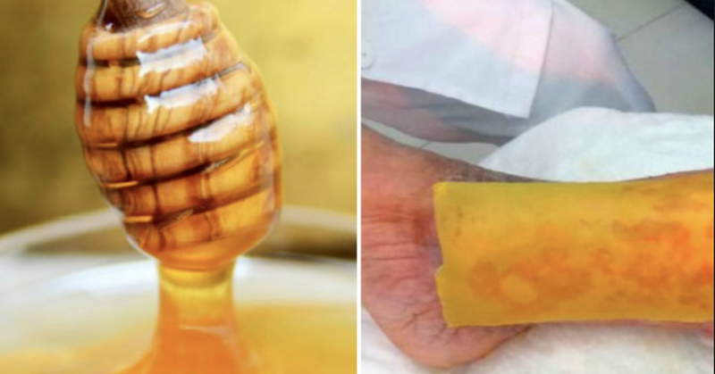 Científicos de la UNAM crean parche de miel para diabéticos, sirve para evitar amputaciones.