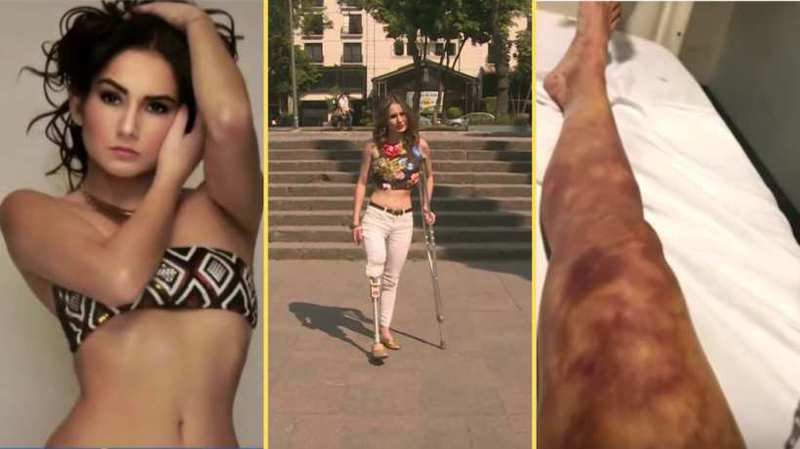 Angélica Díaz, la modelo venezolana que perdió una pierna tras una inyección mal puesta en GDL.