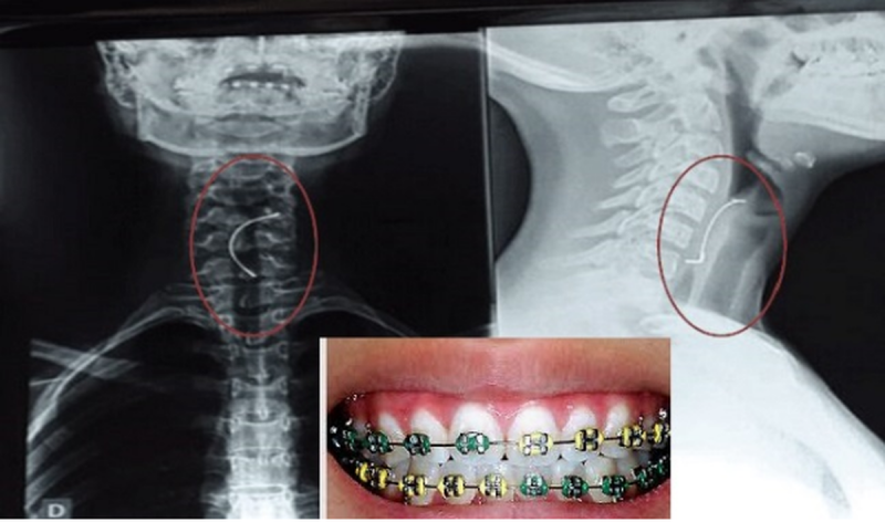 Joven de 15 años se traga por accidente parte de sus brackets y casi muerey