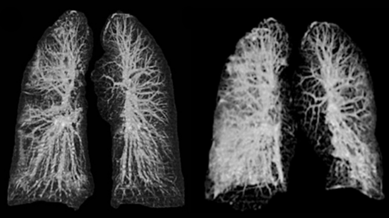 ¡Impresionante! Así es como lucen los pulmones de una persona con COVID-19