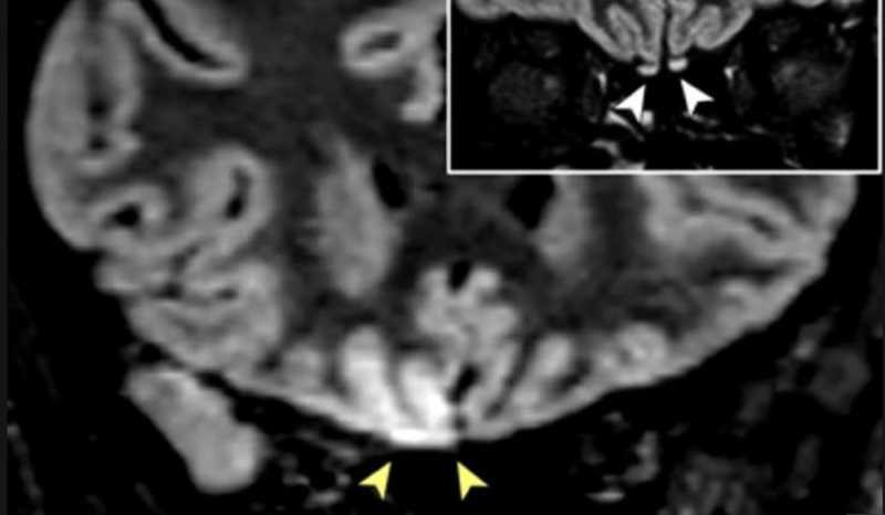 Científicos encuentran EXTRAÑO daño cerebral en paciente con CORONAVIRUS