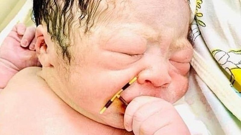 IMPACTANTE: Bebé nace con el DIU de su mamá en la mano