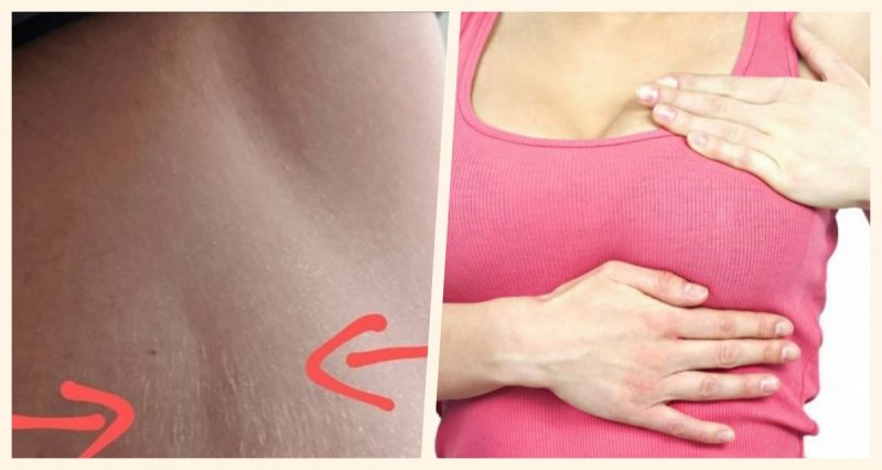 Mujer DESCUBRE que tenía cáncer de mama gracias a marca en forma de ESTRÍA