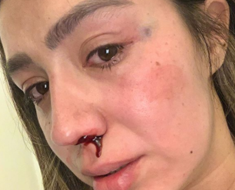 Instagramer REVELA amenazas de las que ha sido víctima tras sufrir GOLPIZA por parte de su pareja