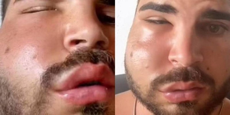 Joven español va al dentista en México por fuerte dolor y se le deforma la caray