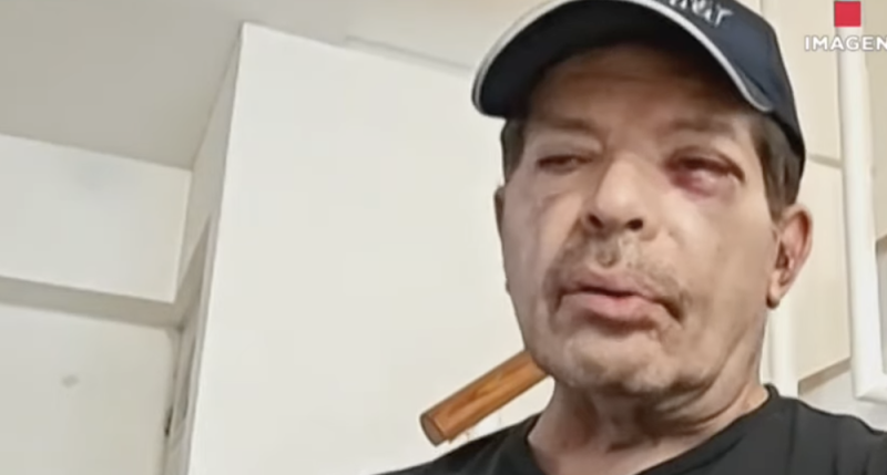 Pepe Magaña reaparece con rostro GOLPEADO y revela los verdaderos motivos de sus lesiones