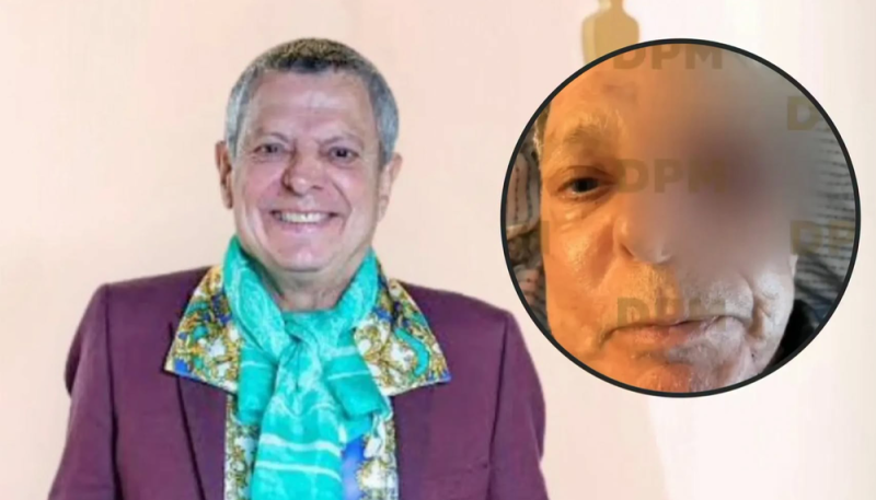 ¡César Bono PIERDE su ojo tras detectarle TUMOR! Este es su estado de salud