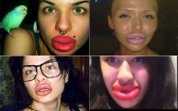 Esta es la espantosa moda de las”labios gigantes”, cada vez más jóvenes se suman