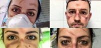 Médicos y enfermeras muestran las  marcas que el COVID-19 ha dejado en sus rostros