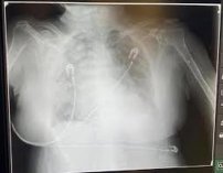 “Les salió caro el festejo del 10 de Mayo”, ENFERMERO a pacientes con Covid-19